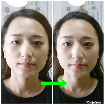 小顔矯正