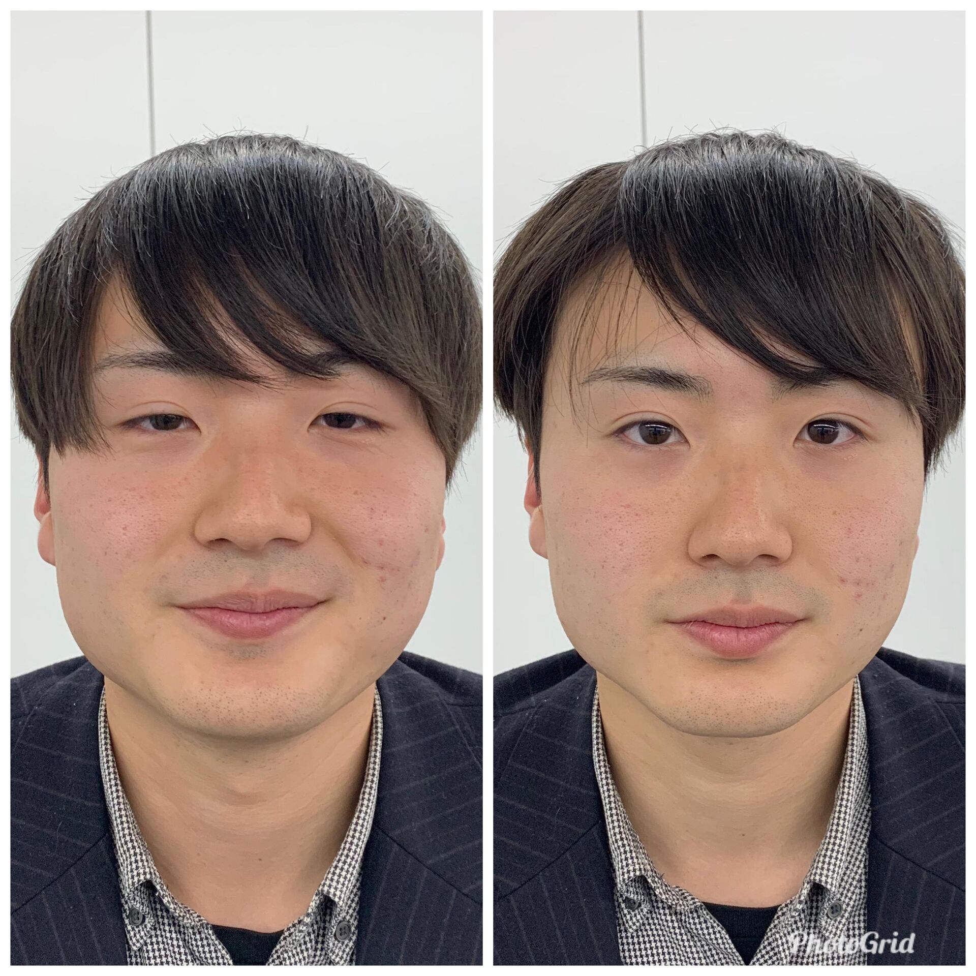 小顔矯正